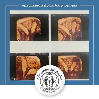 تصویر سه بعدی رحم