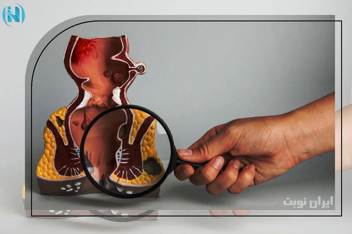 فیستول مقعدی چگونه ایجاد می شود؟