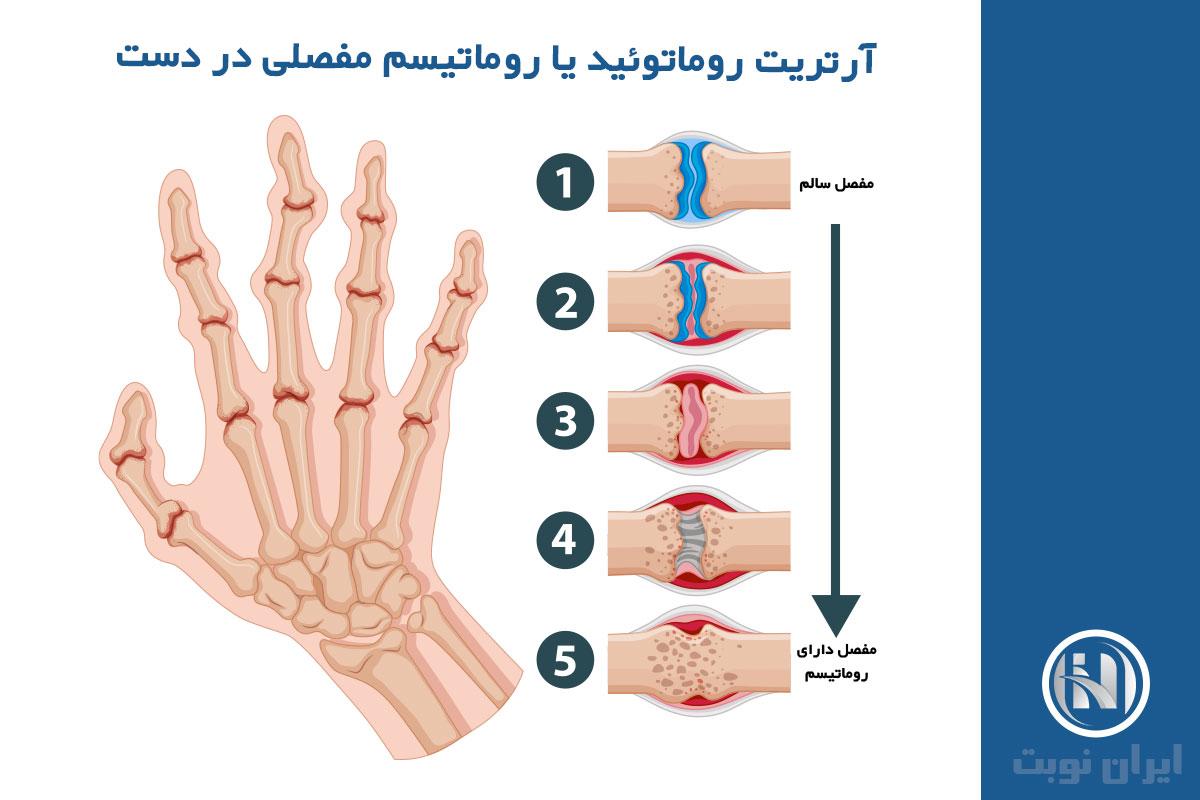 روماتیسم مفصلی چیست و چه علت هایی دارد؟