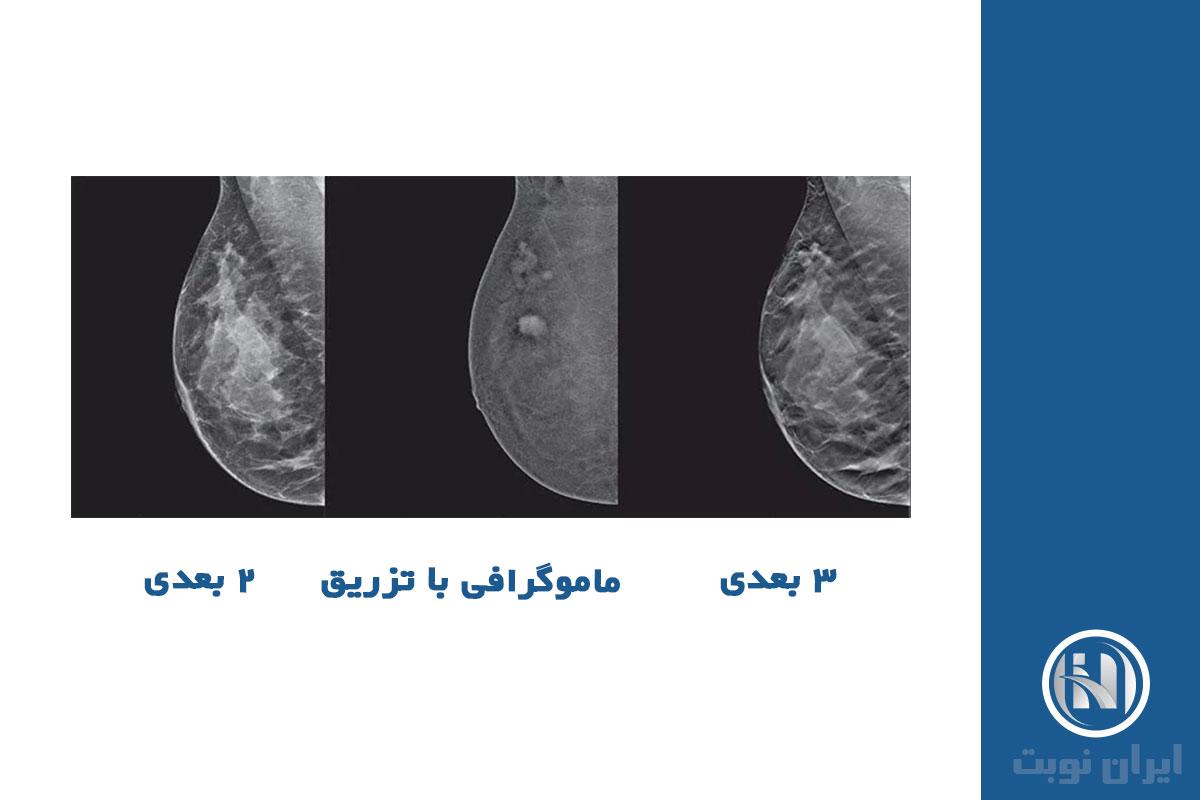 چگونگی انجام ماموگرافی تزریقی