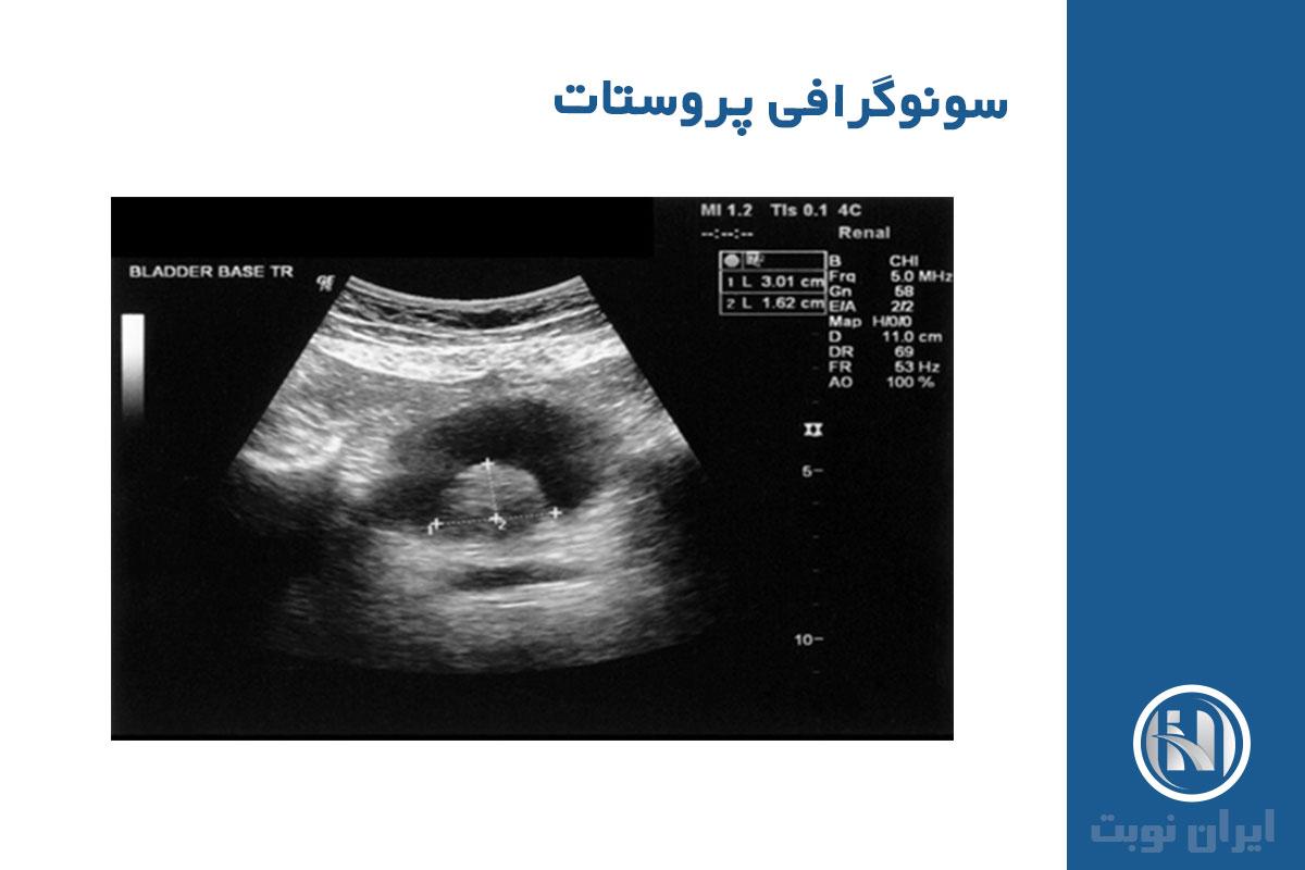 نحوه انجام Ultrasound Prostate