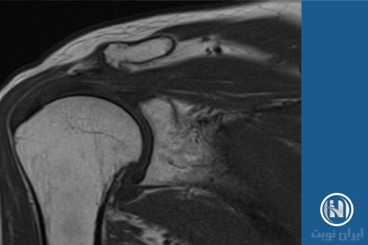 روند آمادگی برای shoulder MRI