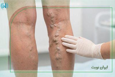 آیا واریس خطرناک است؟ عوارض نادیده گرفتن رگ‌های واریسی