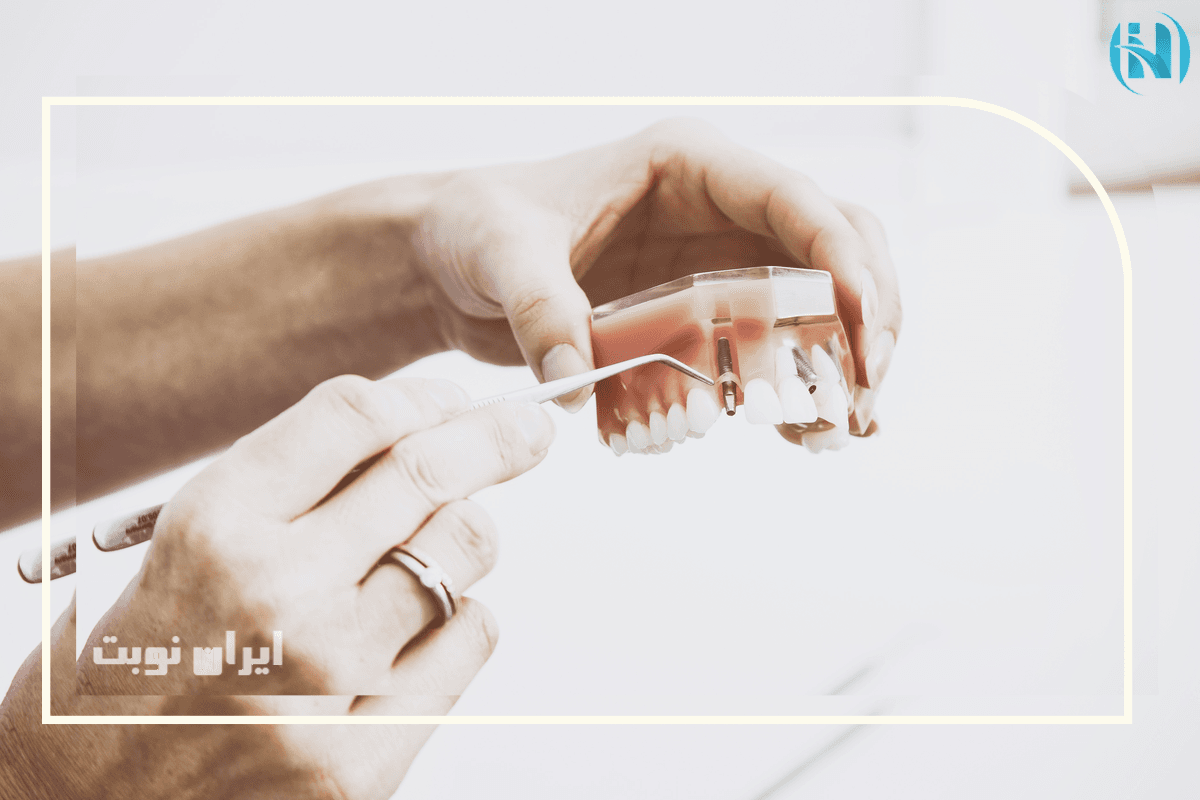 ایمپلنت دندان چیست؟ مراحل کاشت، درد، مدت درمان و عوارض