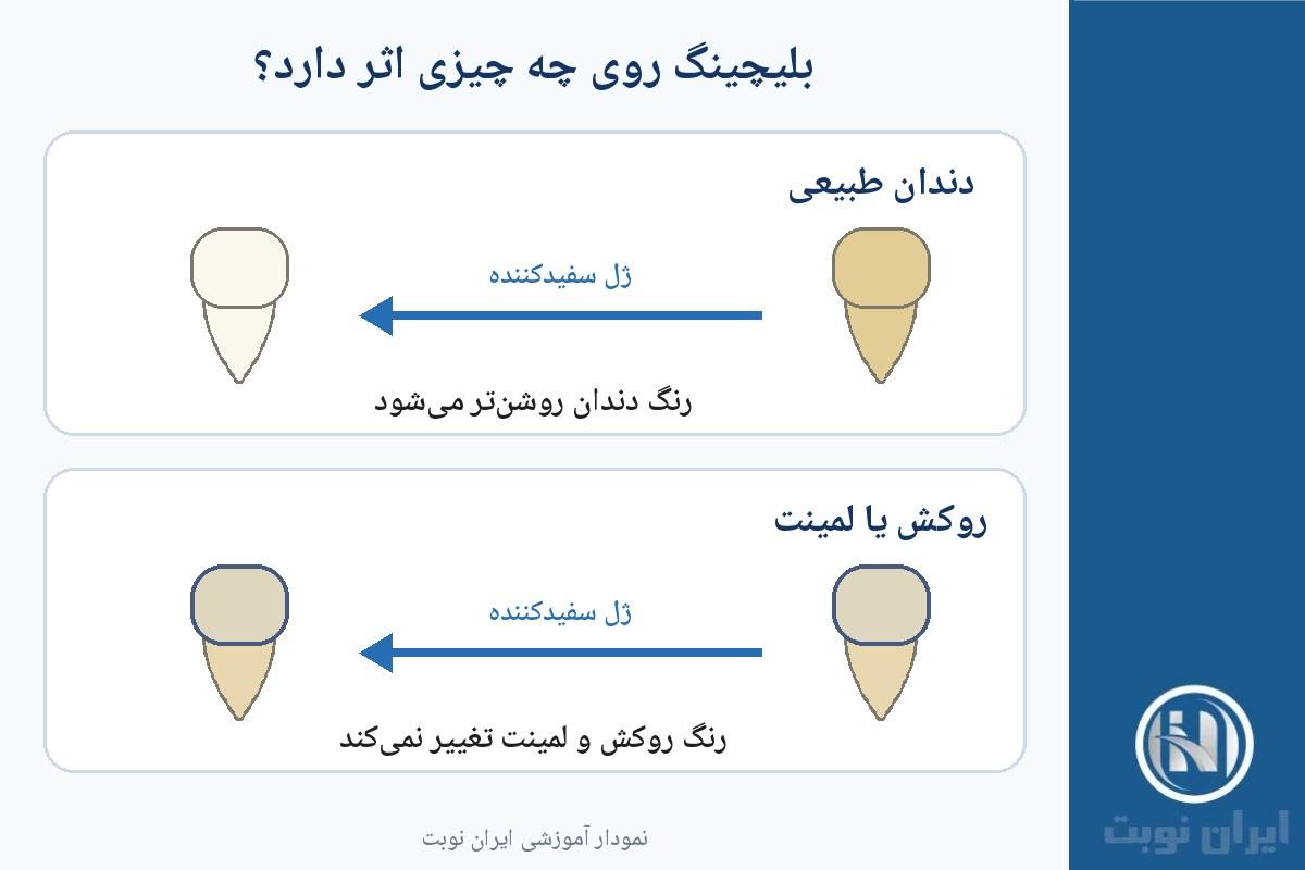بلیچینگ روی روکش، لمینت و پرکردگی اثر دارد؟