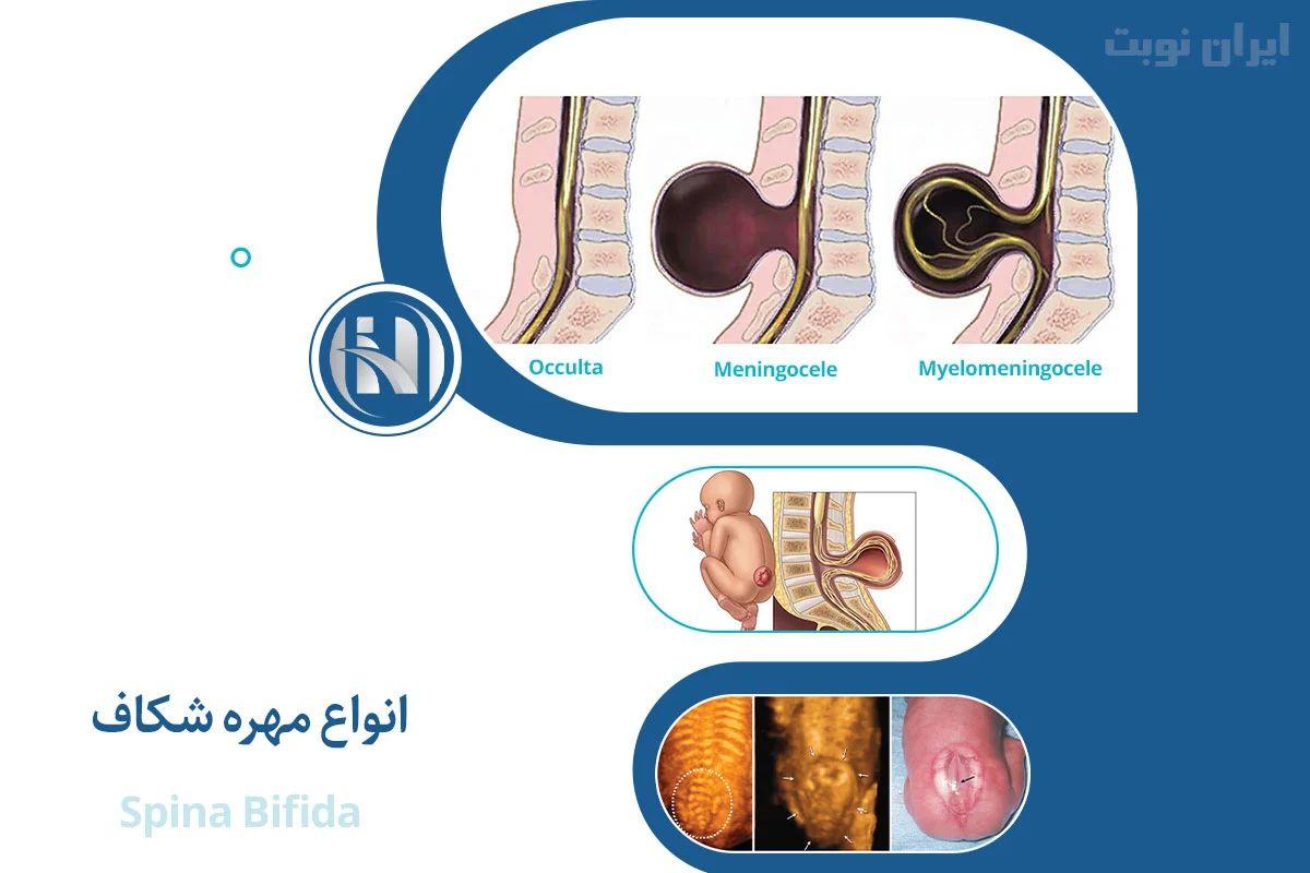 انواع اسپینا بیفیدا انواع اسپینا بیفیدا