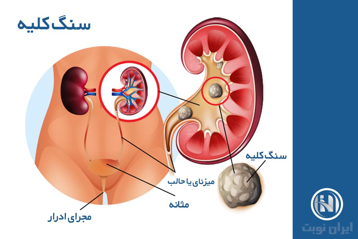 سنگ کلیه چیست و سونو چه چیزی نشان میدهد؟ سنگ کلیه چیست و سونو چه چیزی نشان میدهد؟