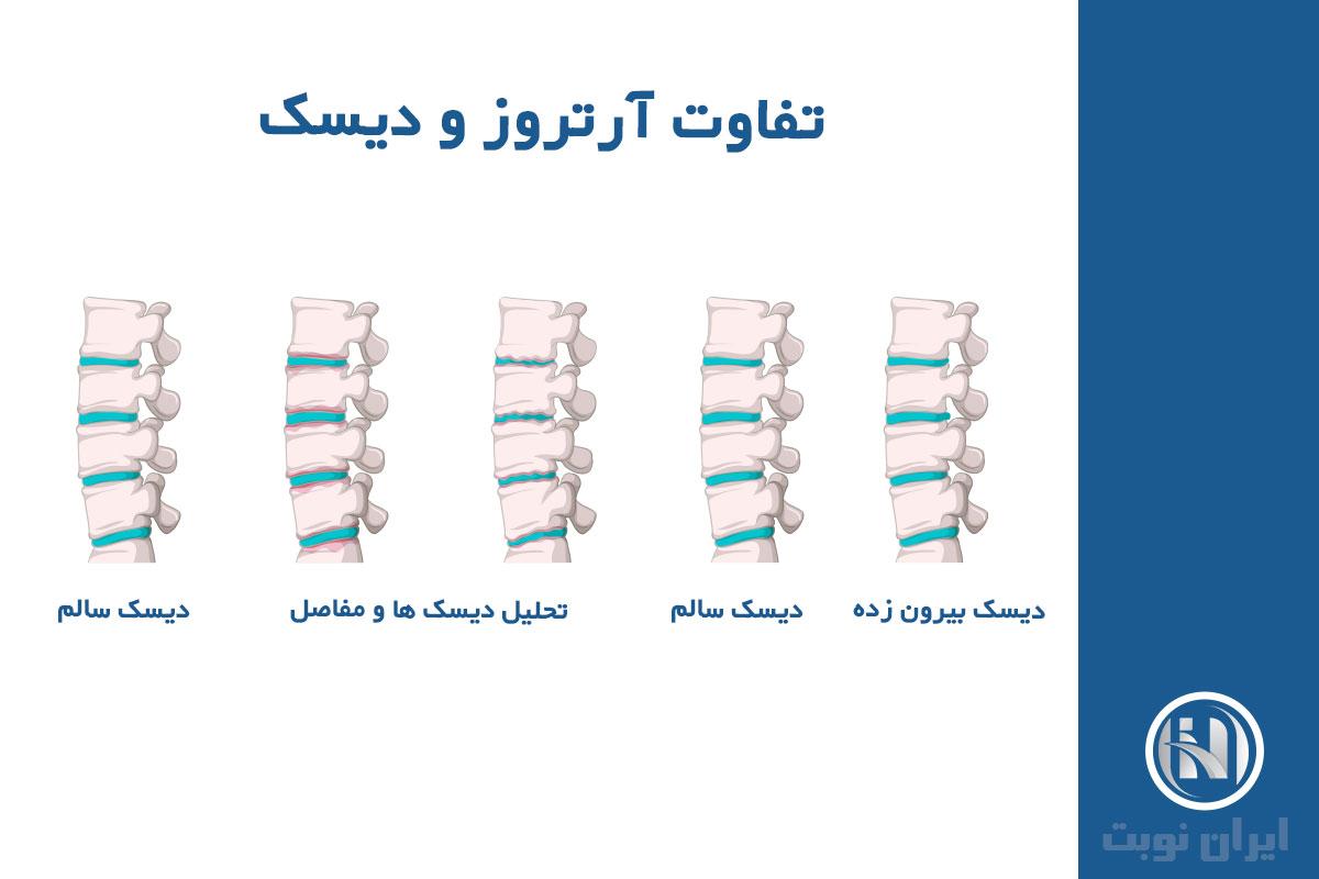 تفاوت آرتروز و دیسک گردن تفاوت آرتروز و دیسک گردن