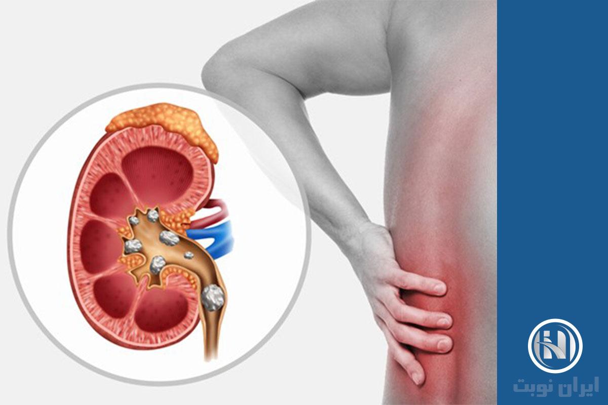 تشخیص سنگ کلیه با سی تی اسکن تشخیص سنگ کلیه با سی تی اسکن