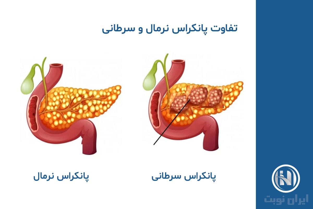 انواع سرطان پانکراس انواع سرطان پانکراس