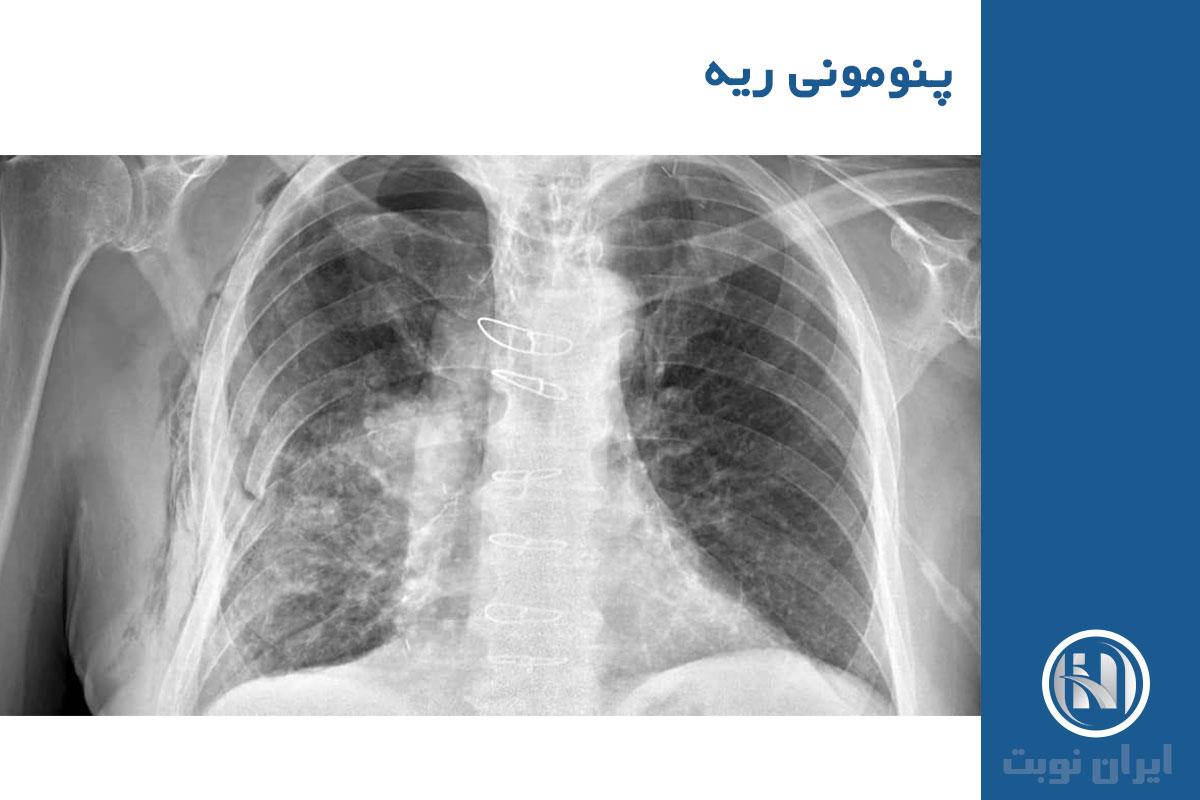 تشخیص پنومونی ریه تشخیص پنومونی ریه