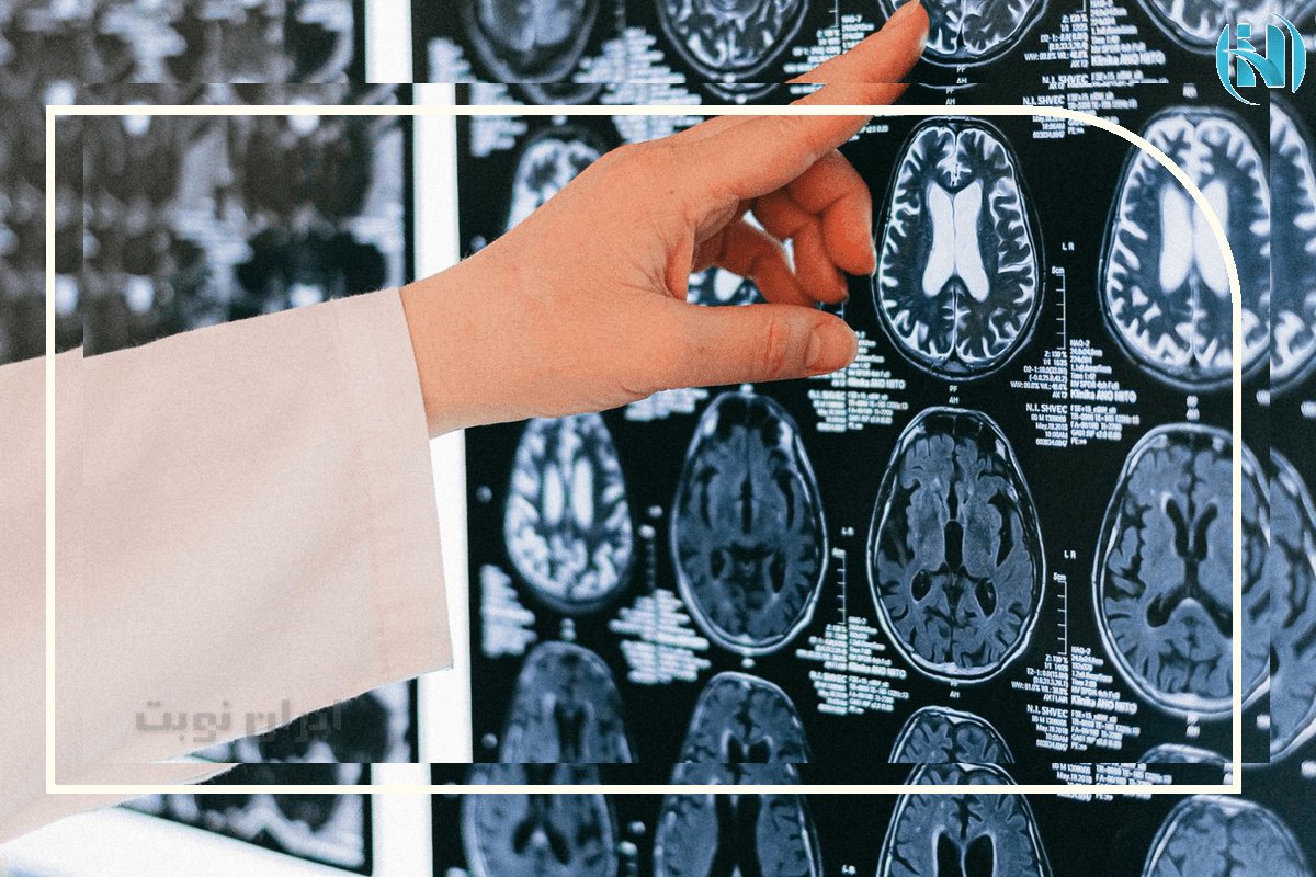 علائم آلزایمر شدید چیست؟ علائم آلزایمر شدید چیست؟