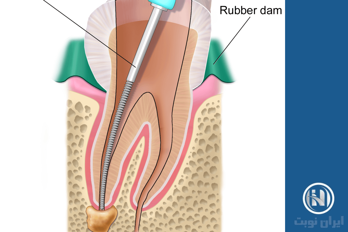 عصب کشی دندان چیست؟ عصب کشی دندان چیست؟