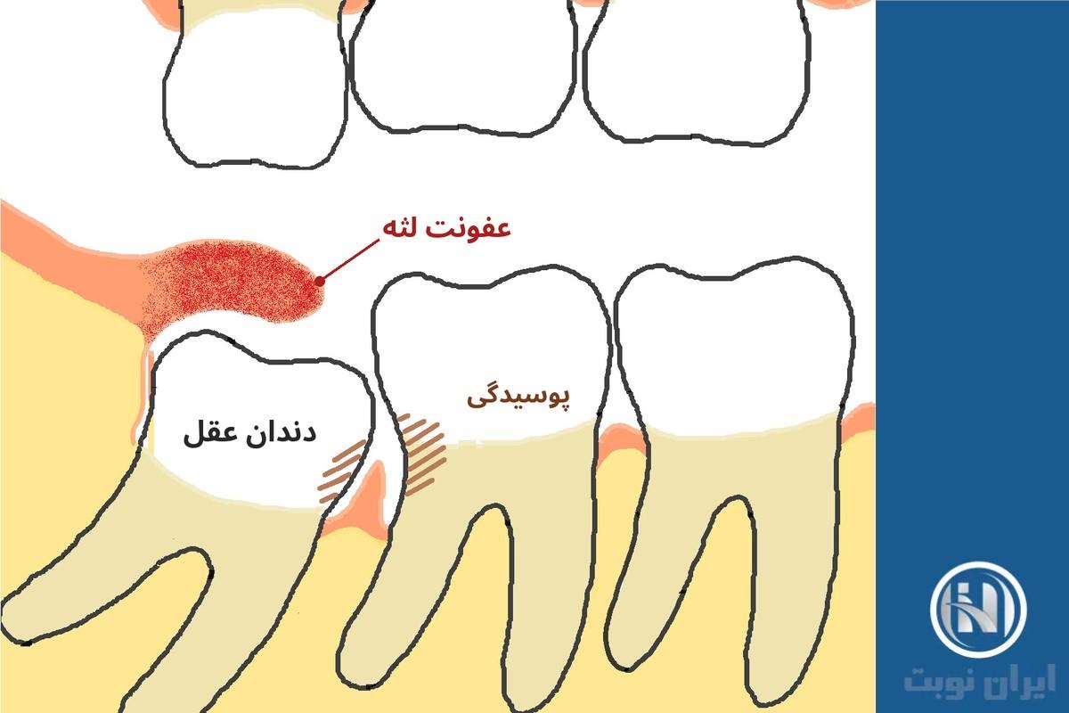 علائم مشکل دندان عقل و عفونت آن علائم مشکل دندان عقل و عفونت آن