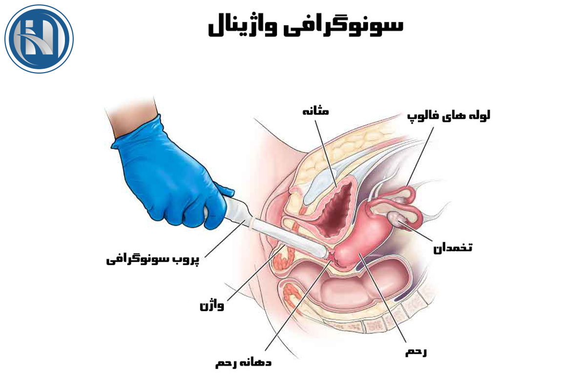 موارد کاربرد سونوگرافی داخلی