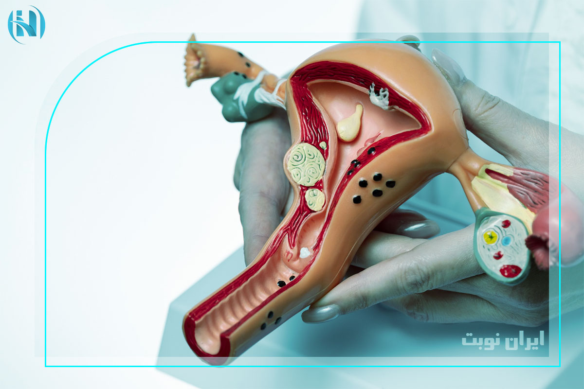 کیست تخمدان چیست؟ از تشخیص تا درمان آن