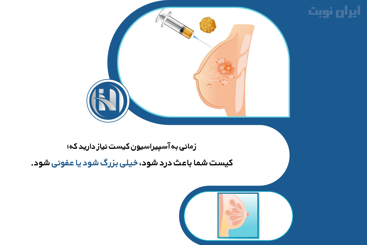 آیا همه کیست های سینه نیاز به آسپیراسیون دارند؟