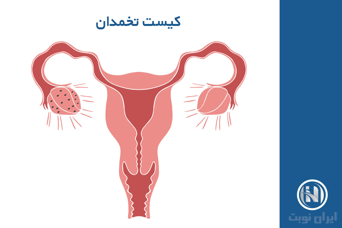 انواع کیست تخمدان