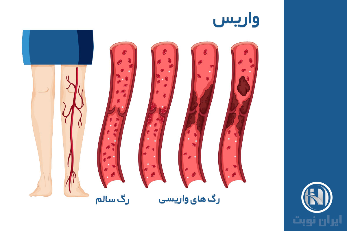 واریس چیست؟