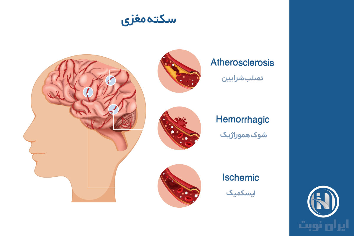 علائم سکته مغزی