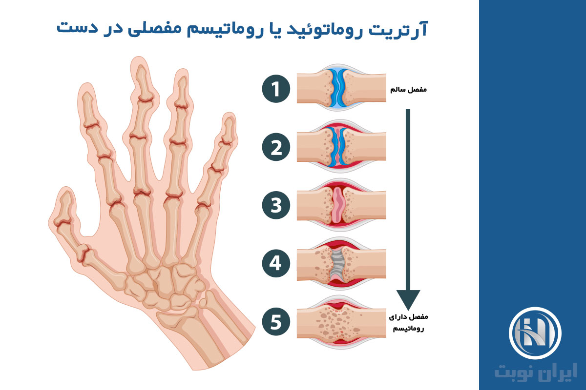 روماتیسم مفصلی چیست و چه علت هایی دارد؟