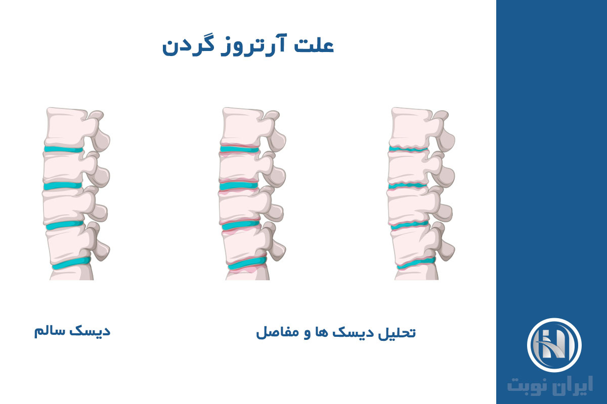 آرتروز گردن چیست؟