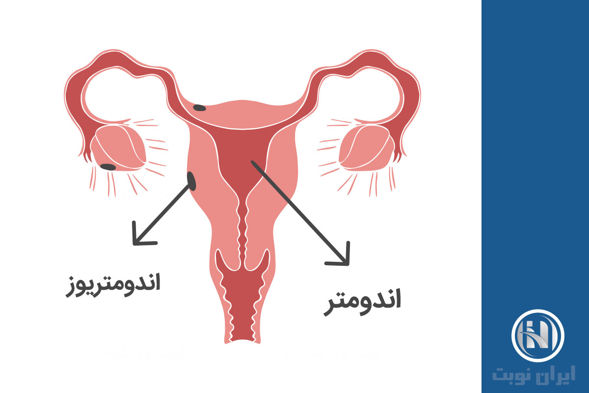 اندومتریوز چیست؟