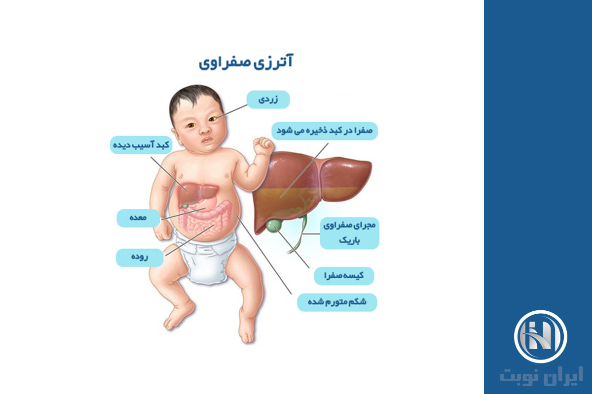 آترزی صفراوی