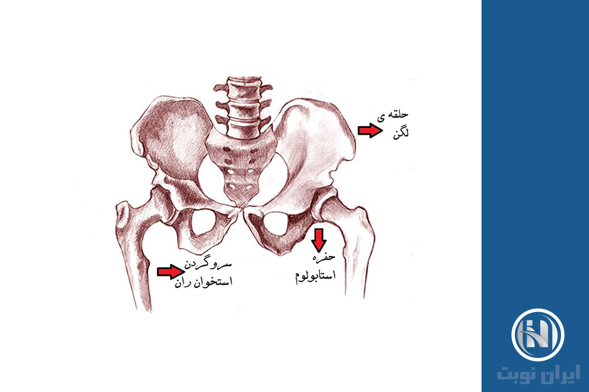 عوارض شکستگی لگن