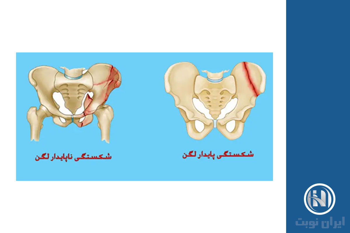 انواع شکستگی لگن