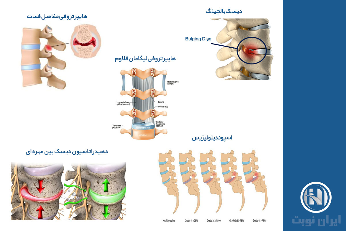 تفسیر Lumbosacral MRI