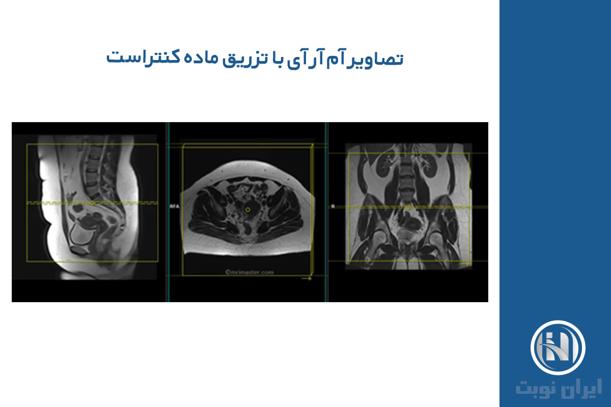 نحوه تفسیر ام آر آی شکم و لگن با تزریق 