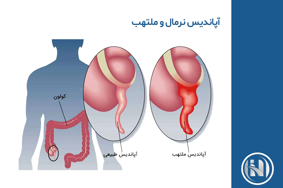 علت التهاب و عفونت