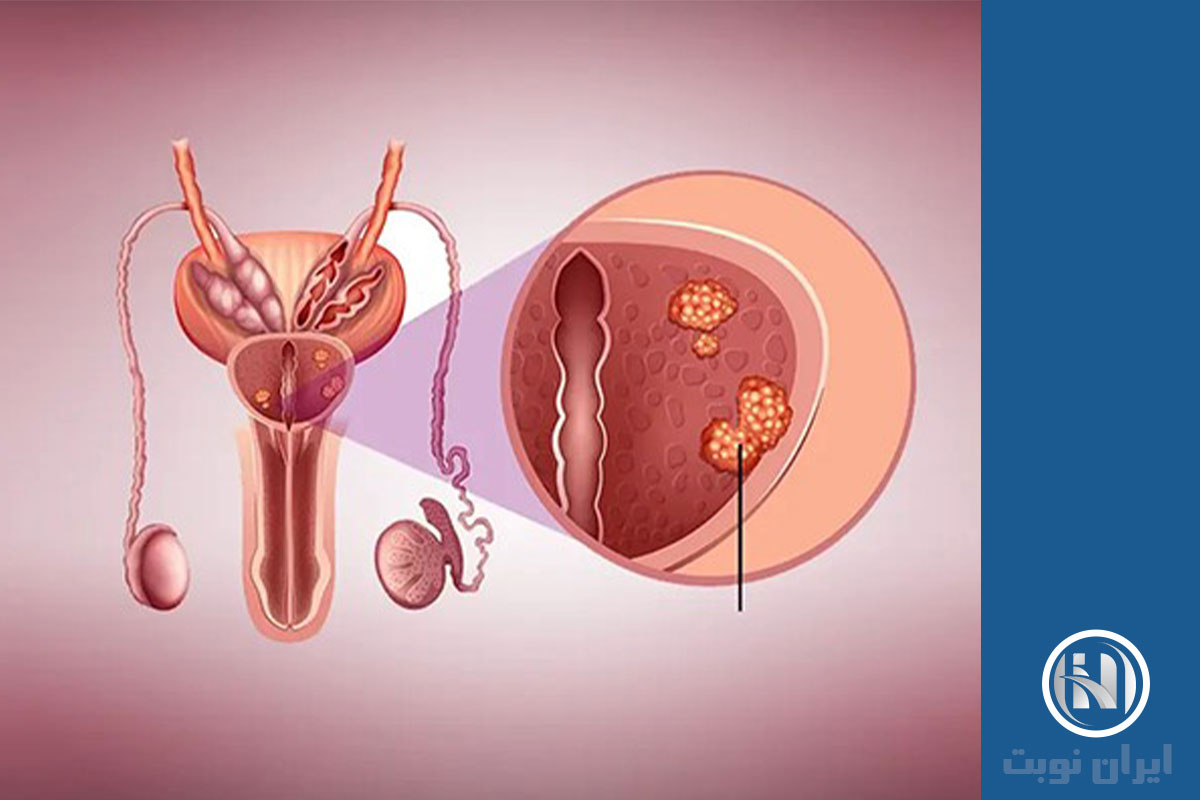 علائم پروستاتیت