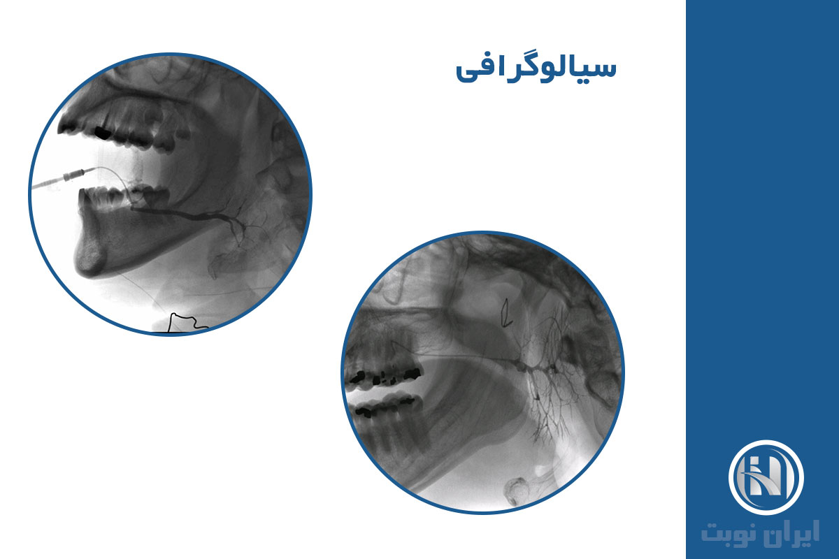 کاربردهای سیالوگرافی در تشخیص بیماری‌ها