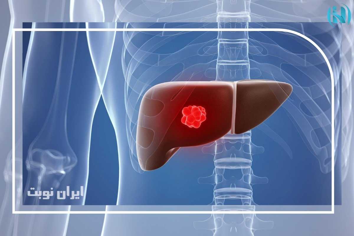 غلبه بر سرطان کبد: راهنمای جامع درمان و پیشگیری