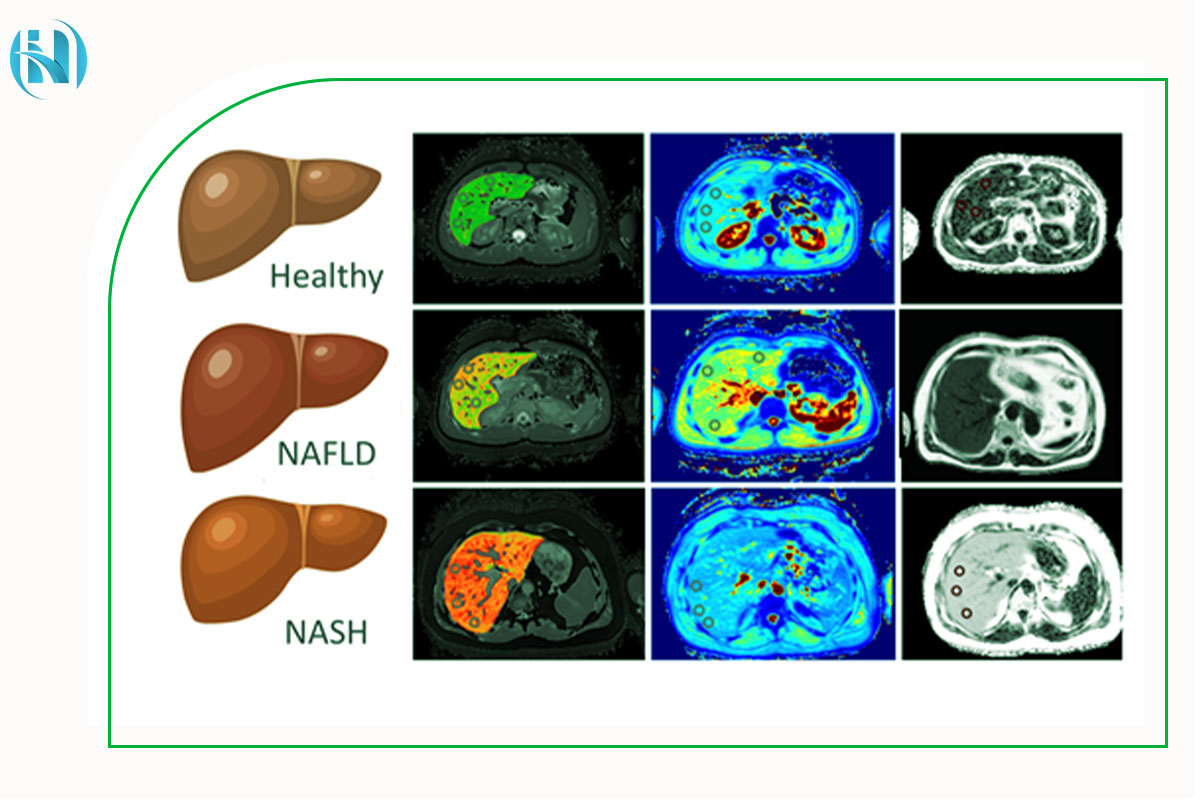 ام آر آی کبد چرا و چگونه انجام می شود؟ 