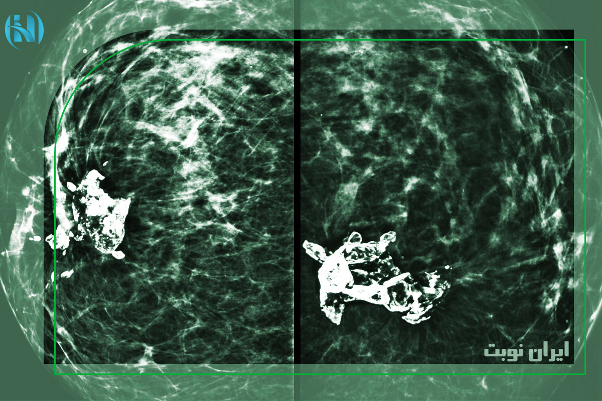 میکروکلسیفیکاسیون در ماموگرافی 