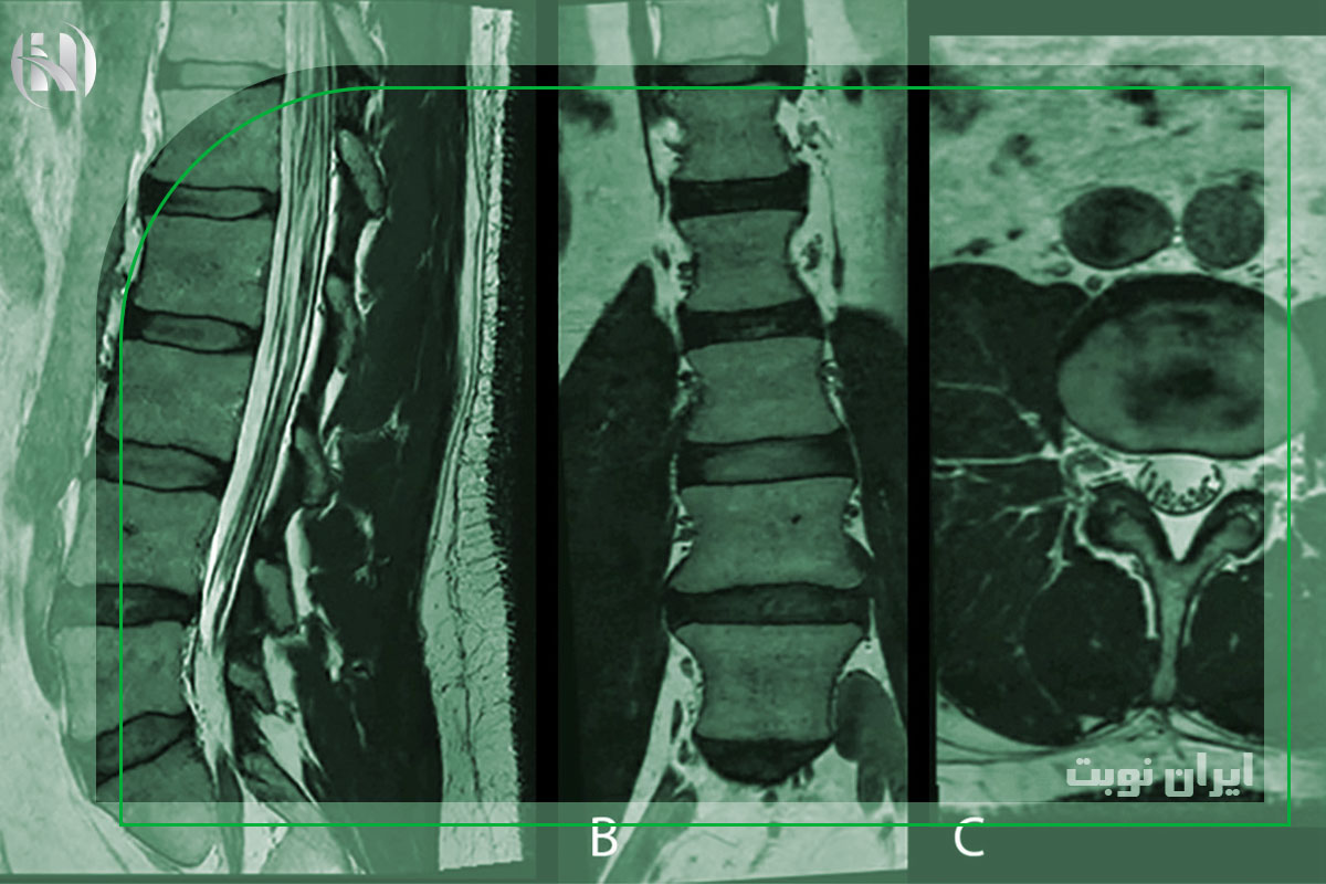 چگونه ام آر آی کمر خود را تفسیر کنیم؟ | راهنمای جامع ایران نوبت