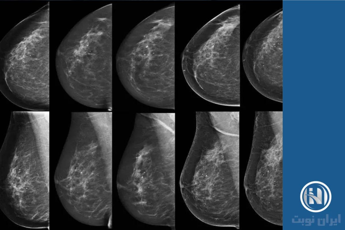 ناقرینگی پستان در ماموگرافی