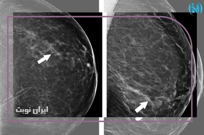 FCMV در ماموگرافی نشانه چیست ؟ 