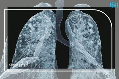 چگونه سی تی اسکن ریه خود را تفسیر کنیم؟ | راهنمای جامع ایران نوبت 