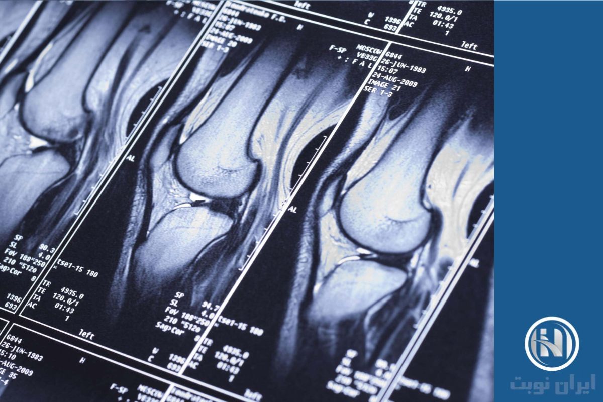 دلایل انجام knee MRI 