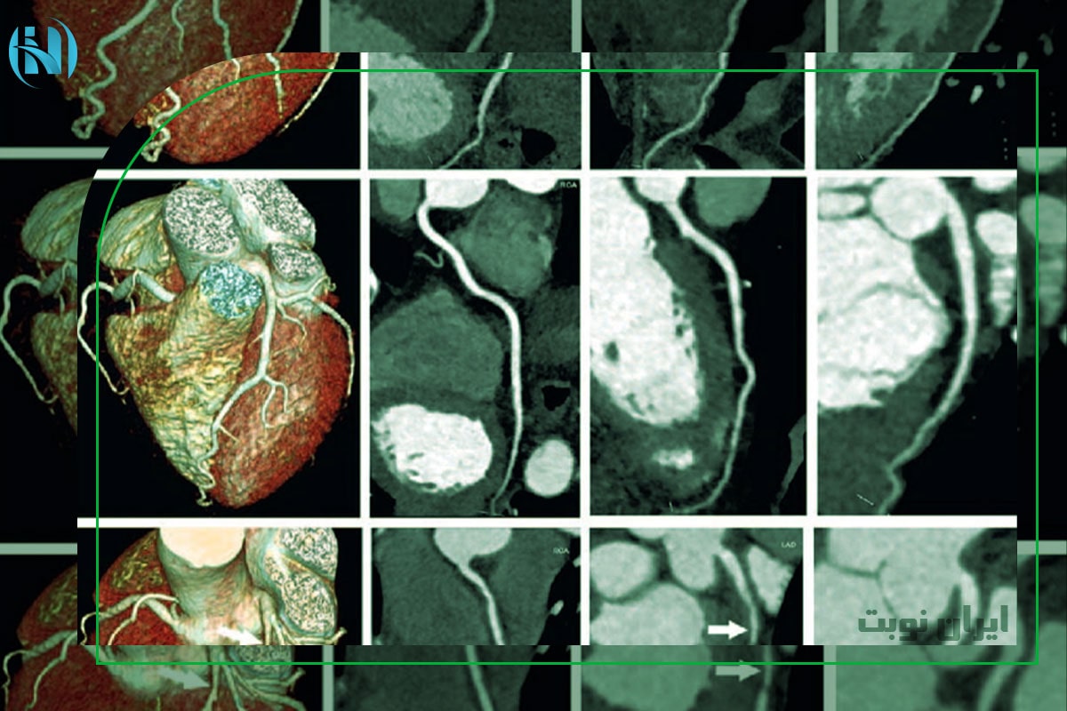 تفسیر و خواندن جواب سی تی اسکن قلب 
