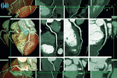 تفسیر و خواندن جواب سی تی اسکن قلب 