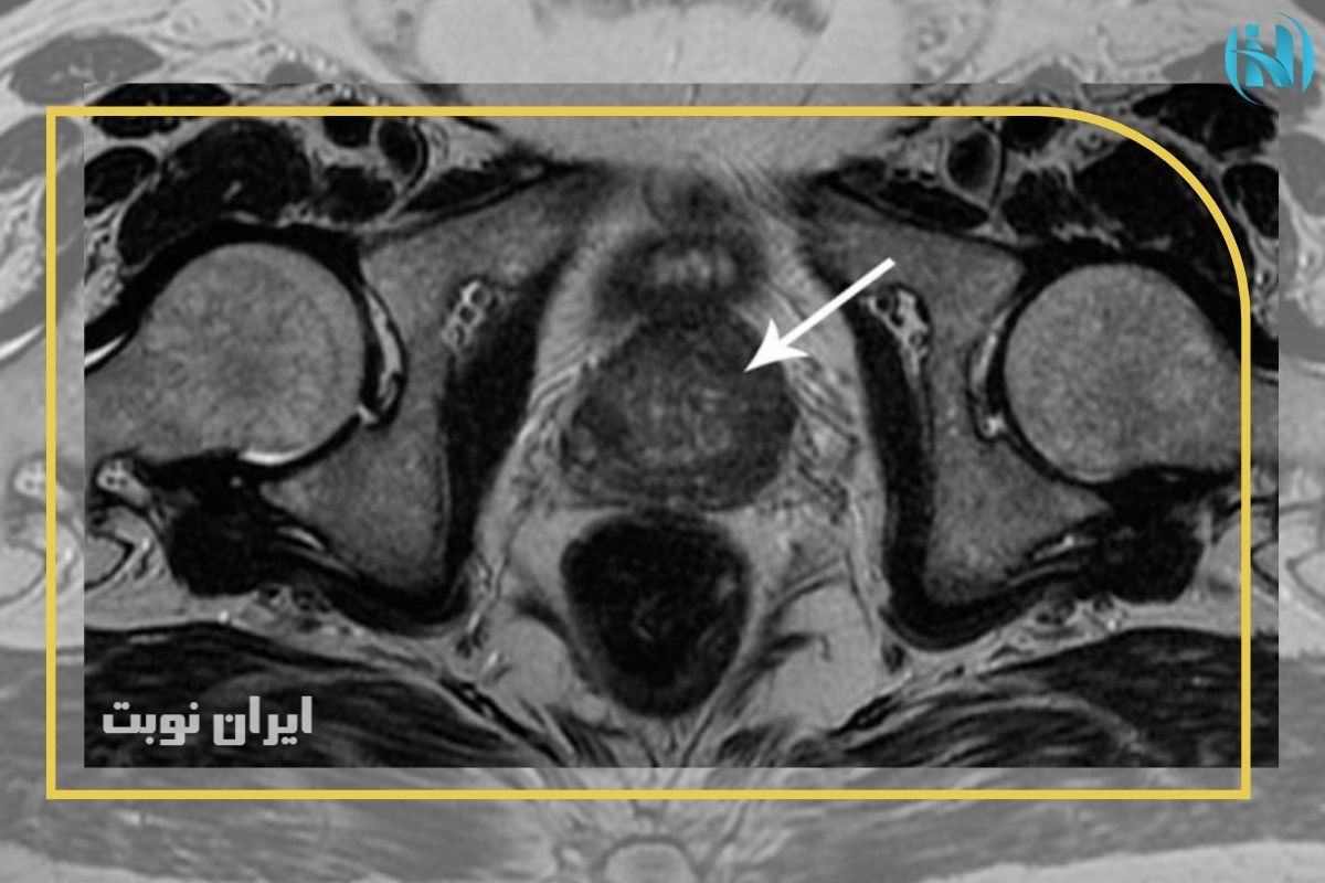 چگونه گزارش ام آر آی پروستات خود را بخوانیم؟ 