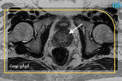 چگونه گزارش ام آر آی پروستات خود را بخوانیم؟ 
