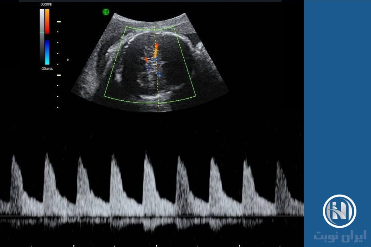 سونوگرافی داپلر بارداری و اهمیت آن