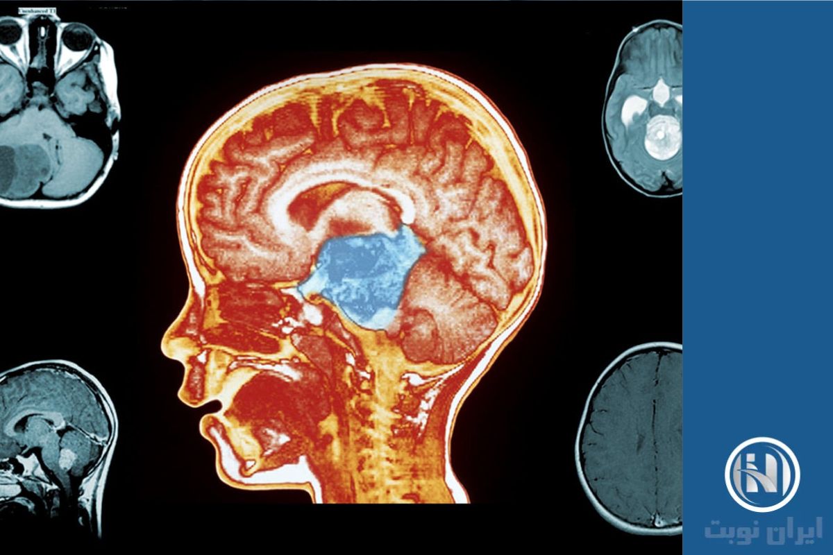 روش‌های تشخیص تومور مغزی در کودکان